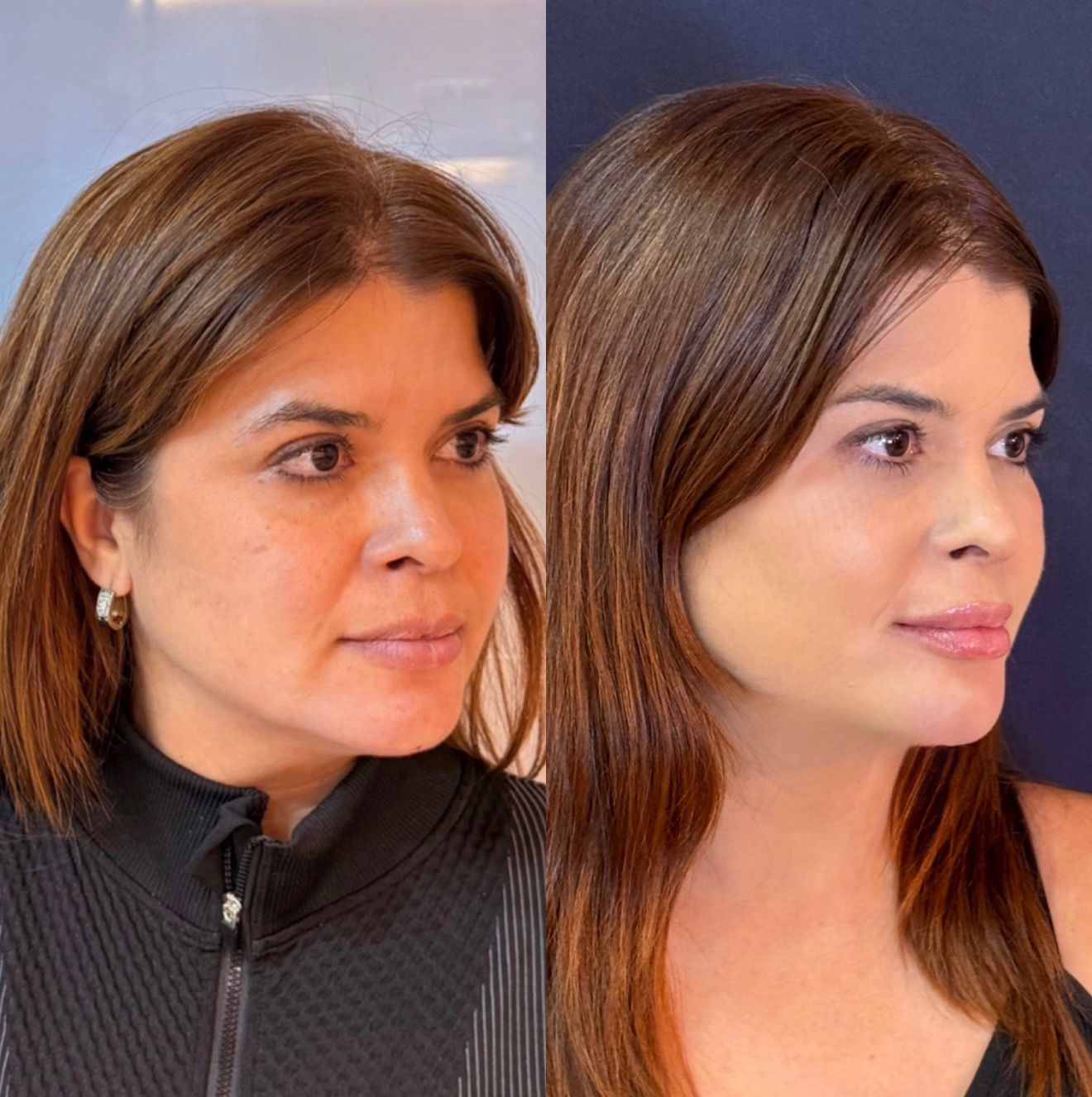 Resultado Harmonização Facial — Antes e Depois